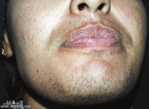 تجربتي في التخلص من الشعرانية علاج الشعرانية عند النساء بشكل نهائي