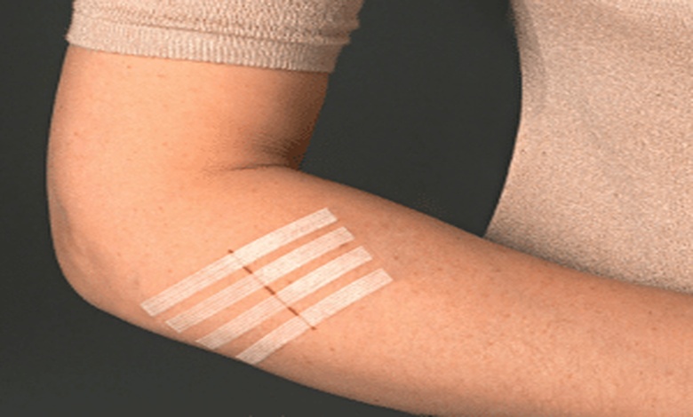 كيفية استخدام steri strip
