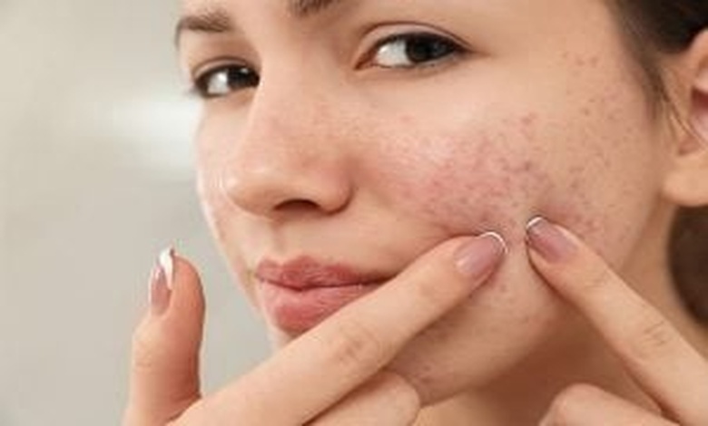 كيفية استخدام acne stop