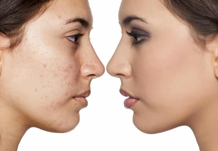 إزالة تصبغات الوجه في أسبوع