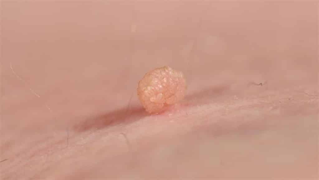 الفرق بين الزوائد الجلدية والثاليل