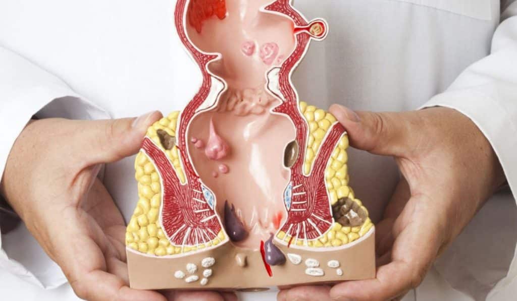 الفرق بين الناسور والبواسير