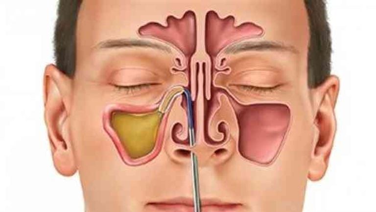 تجاربكم مع علاج الجيوب الانفيه