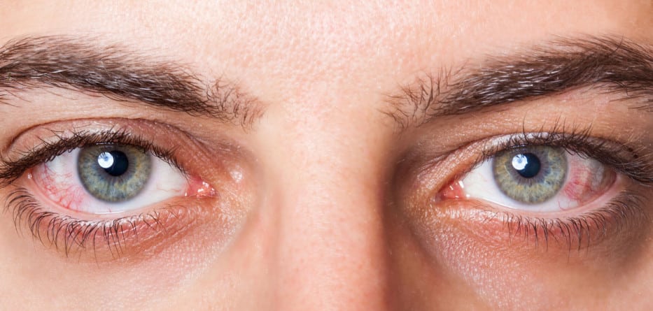 تجربتي مع جفاف العين