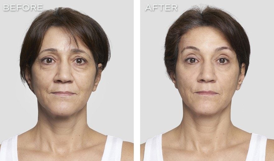 تجربتي مع شد الوجه بالخيوط