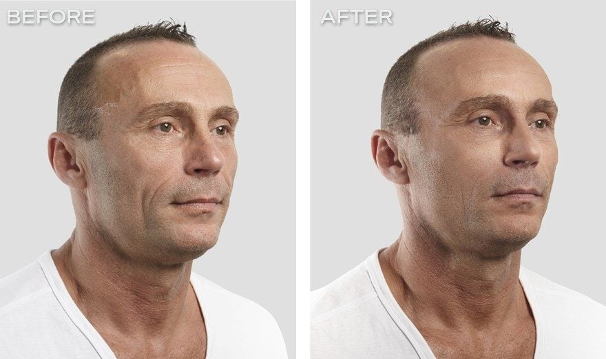 تجربتي مع شد الوجه بالخيوط