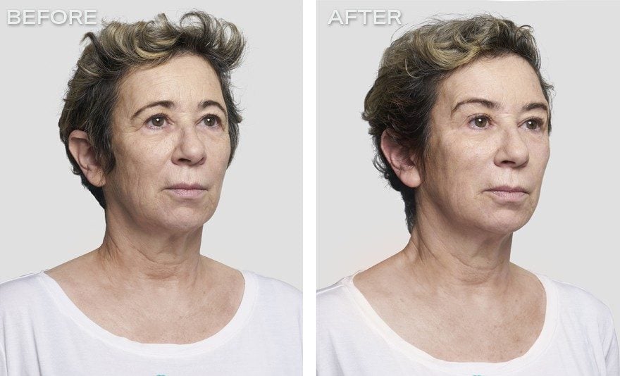 تجربتي مع شد الوجه بالخيوط