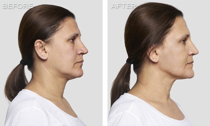 تجربتي مع شد الوجه بالخيوط