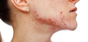 تجربتي مع علاج الحبوب تحت الجلد