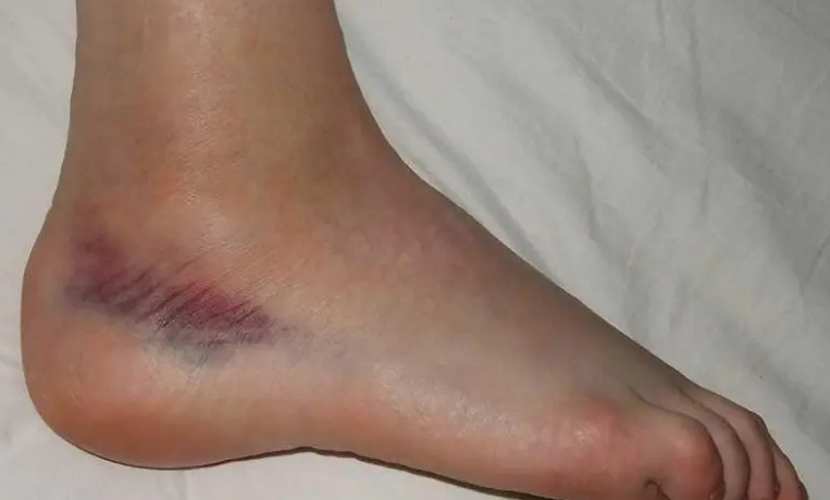 علاج الغرغرينا في الطب النبوي