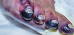 علاج الغرغرينا في المدينة