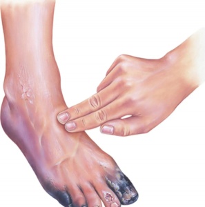 علاج الغرغرينا في جدة