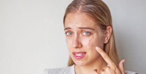 علاج بقع حب الشباب : أفضل طريقة لعلاج بقع حب الشباب