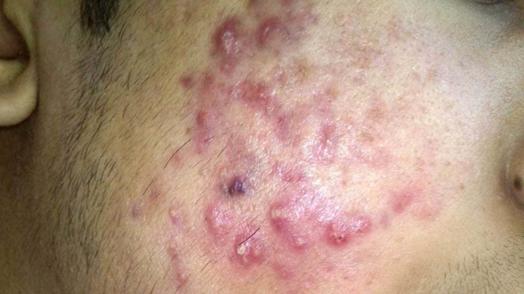 علاج بقع حب الشباب : أفضل طريقة لعلاج بقع حب الشباب