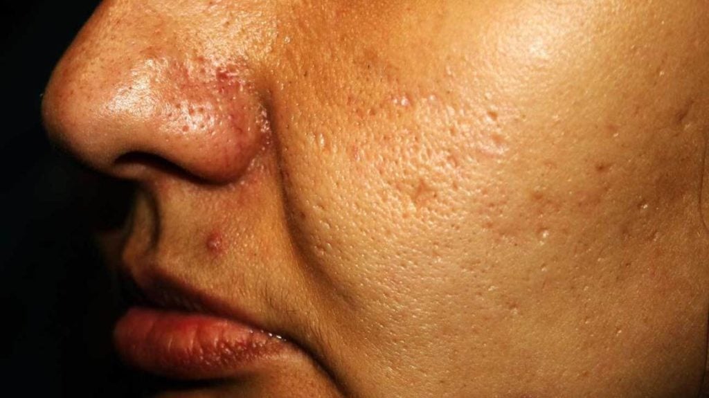 علاج بقع حب الشباب : أفضل طريقة لعلاج بقع حب الشباب