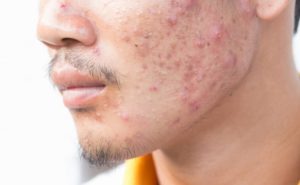 دعاء لشفاء الوجه من الحبوب