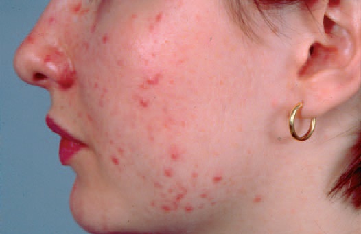 دعاء لشفاء الوجه من الحبوب