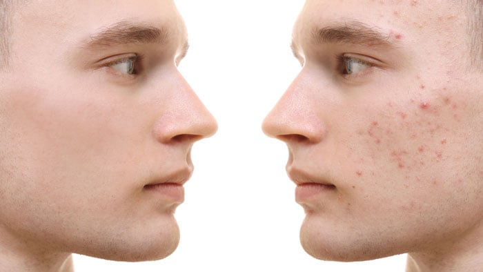 دعاء لشفاء الوجه من الحبوب