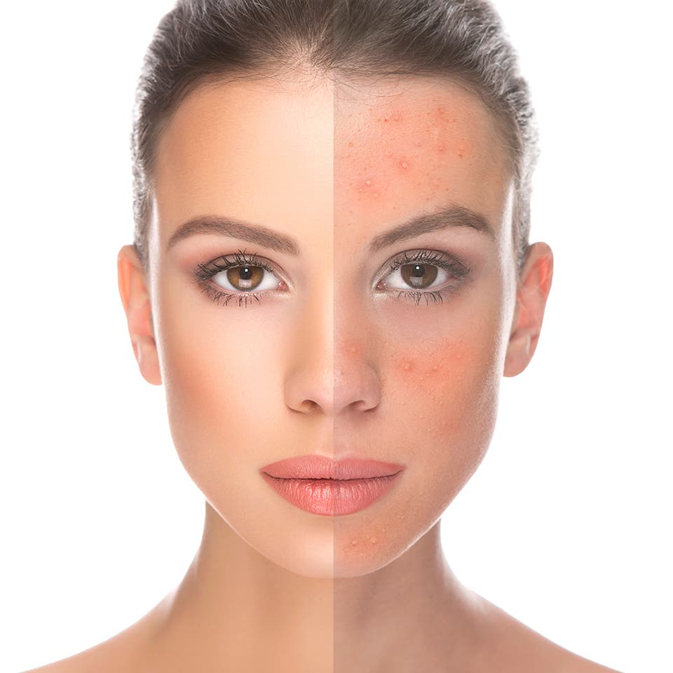 دعاء لشفاء الوجه من حب الشباب