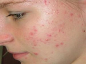 دعاء لشفاء الوجه من حب الشباب