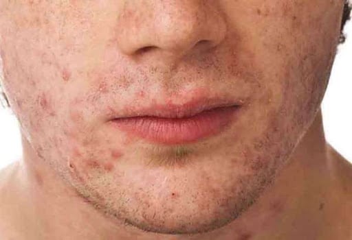 دعاء لشفاء الوجه من حب الشباب